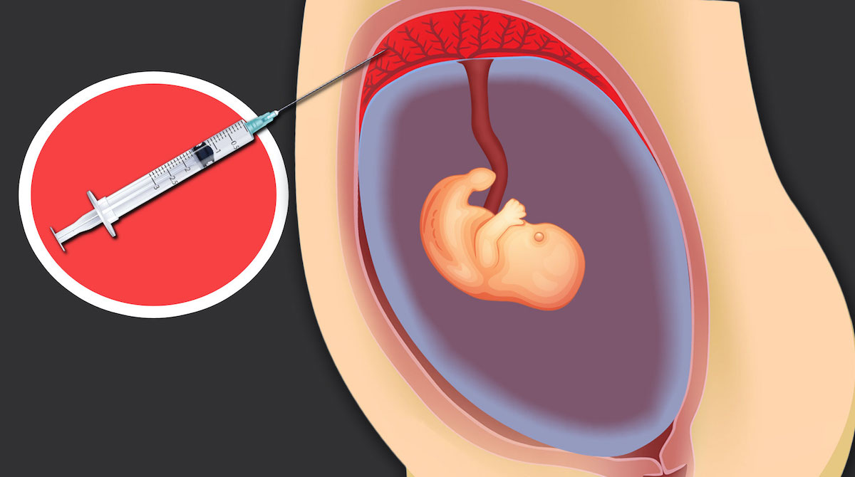 What is a chorionic villus sampling test?