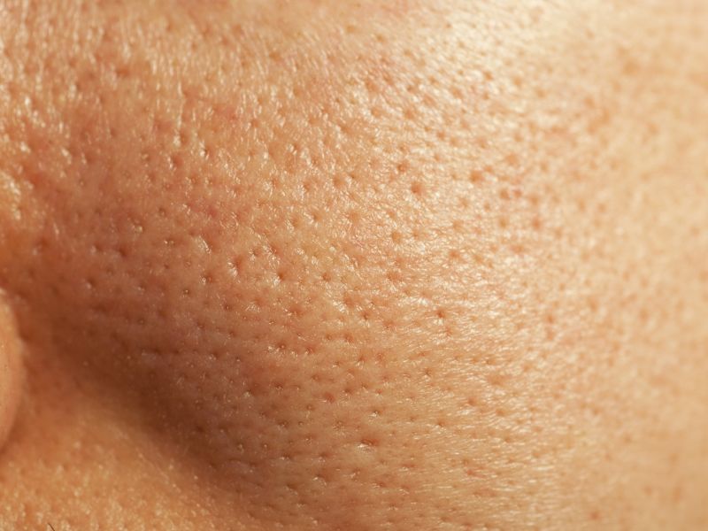 Large pores - The enemy of smooth skin