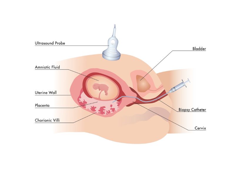 A chorionic villus sampling test