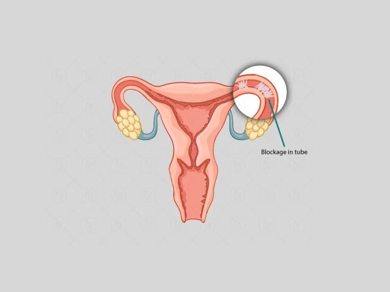 Signs and symptoms of fallopian tube blockage