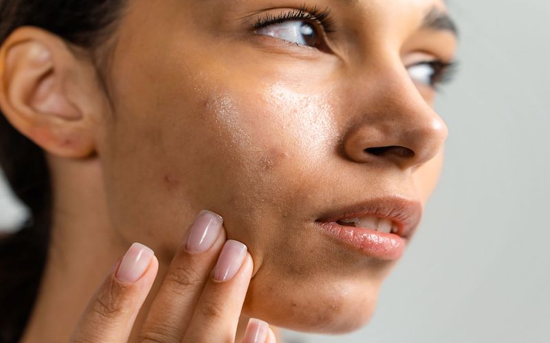 Which skin type are you? Oily Skin