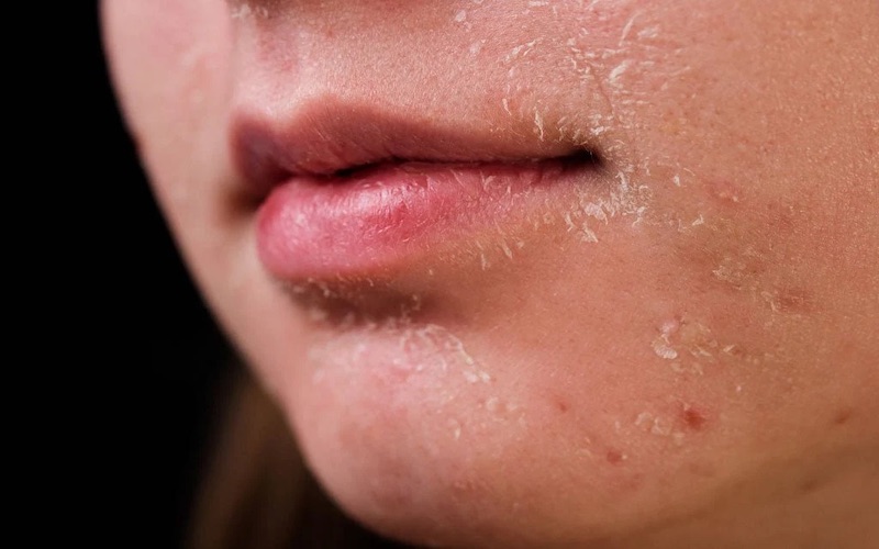 Which skin type are you? Dry Skin