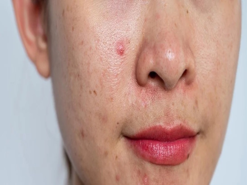 How to treat acne for oily skin the secret to getting rid of acne for oily skin