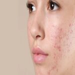 How to treat acne for oily skin effectively at home