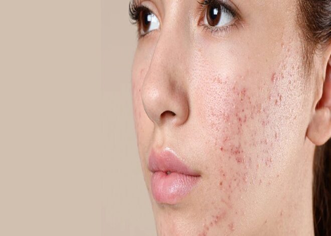 How to treat acne for oily skin effectively at home