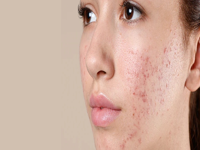 How to treat acne for oily skin effectively at home