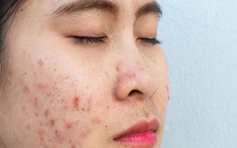 Common problems with combination skin