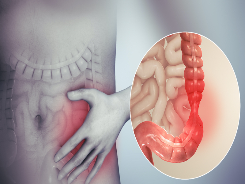 Irritable Bowel Syndrome (IBS) Definition